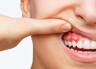 Erkrankungen von Mund-/ Zungenschleimhaut und des Zahnfleisches